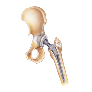 Stryker hip replacement claim